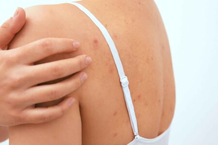 body acne treatment