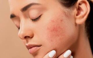 Acne in Adults