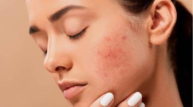 Acne in Adults